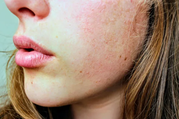 What Is Hyperpigmentation?