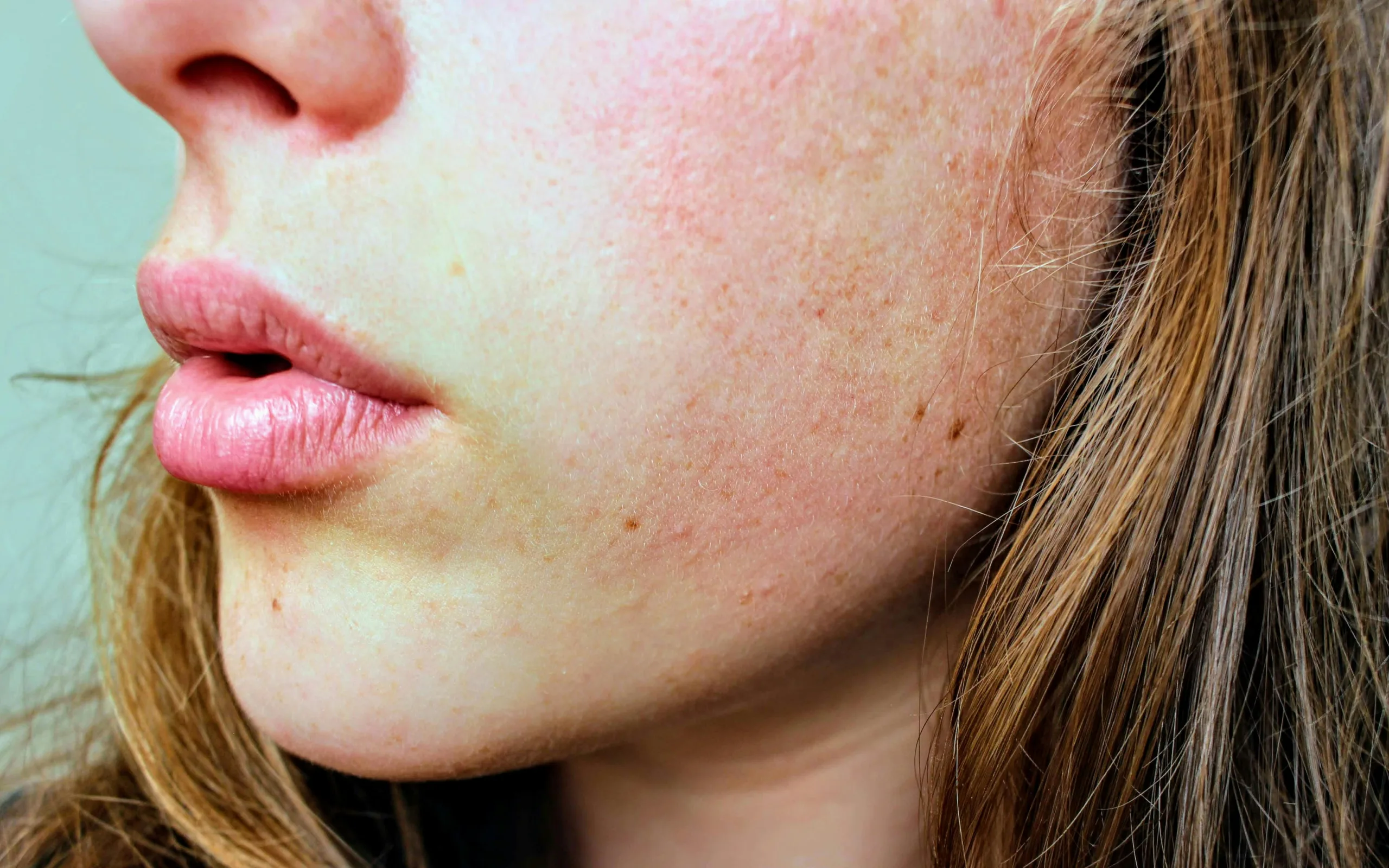 What Is Hyperpigmentation?